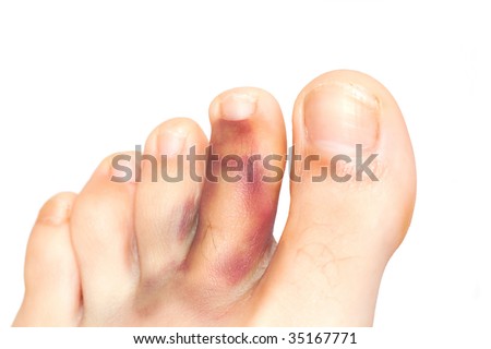 broken toe. stock photo : Broken toe