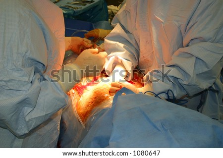 Cesarean section (or operation)