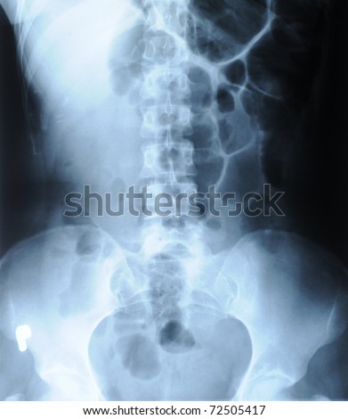 authentic x-ray picture of human backbone