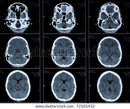 computer tomography CT photo of human brain