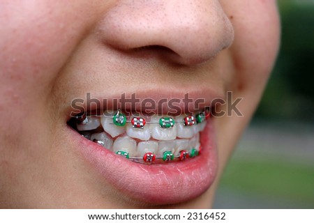 braces smile shutterstock