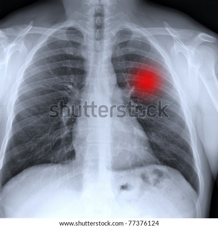 X-ray of cancer in chest / Many others X-ray images in my portfolio.