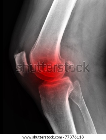 X-ray of painful knee  / Many others X-ray images in my portfolio.