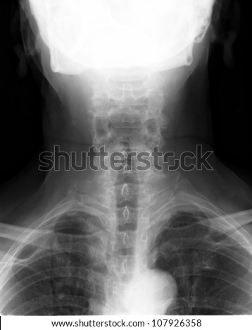 Spinal Column Back Upper Part xray medical image