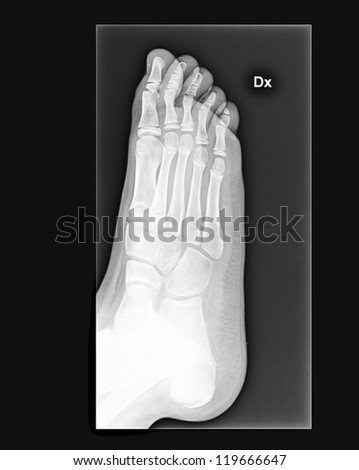 Foot fingers exposed on x-ray black and white film, MRI of right foot.