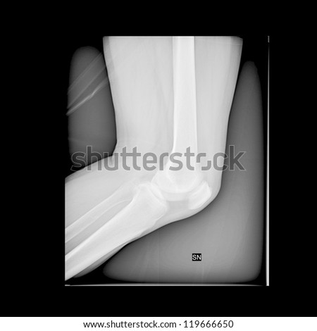 X-ray of human arm. MRI
