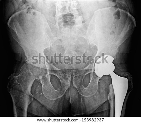 Hip Prosthesis MR - An artificial device used to replace a missing body part