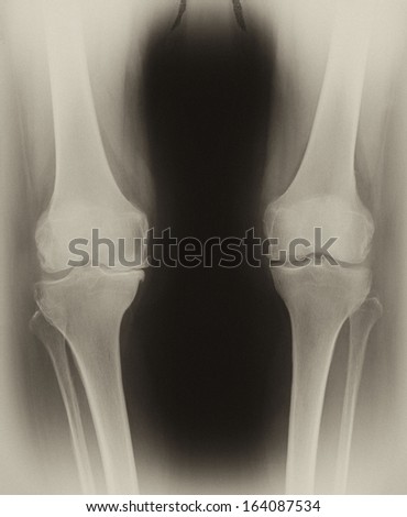 Orthostasis MRI: maintenance of an upright standing posture. In some medical tests a patient may need to maintain orthostasis for a long period to stimulate a rise in aldosterone concentration.