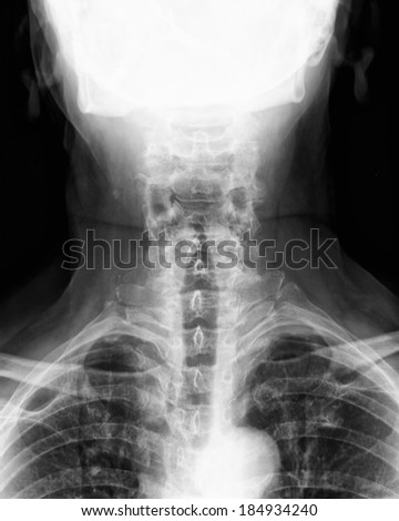 Spinal Column Back Upper Part xray medical image