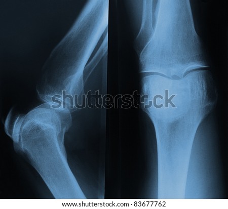 X-ray of the knee. Front and side