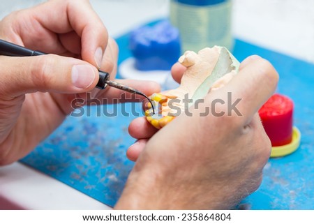 A dental technician remodeling with wax the support teeth after chiseling is done