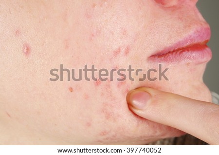 skin with the acne problems