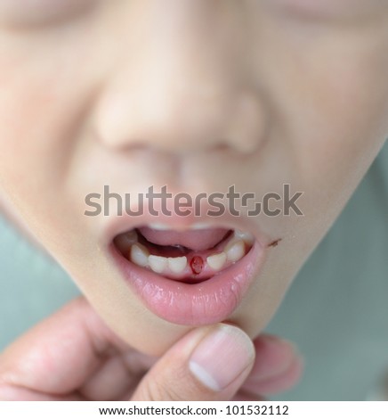 Lost milk tooth boy, Close up view.