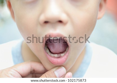 Close up first tooth after loss milk tooth  asian  boy.