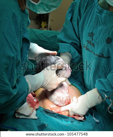 Real operation for cesarean section with new born infant in operating theater.