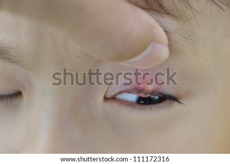 Left upper eyelid small stye in young asian boy close up view.