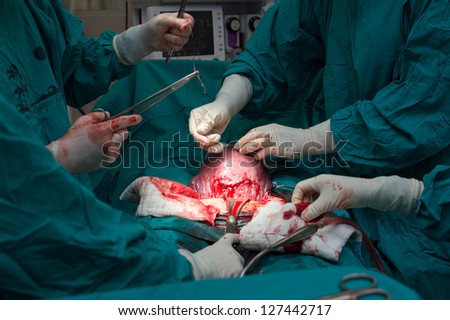 Classic cesarean section in the operating theater.
