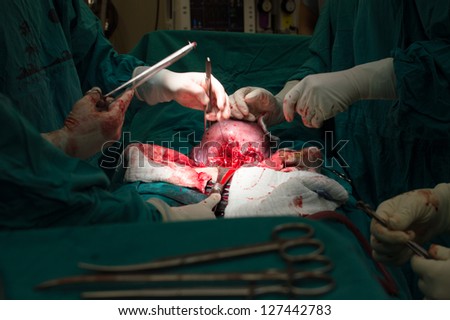 Classic cesarean section in the operating theater.