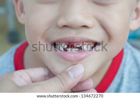 close up of boy mouth with recent loss of upper tooth milk.