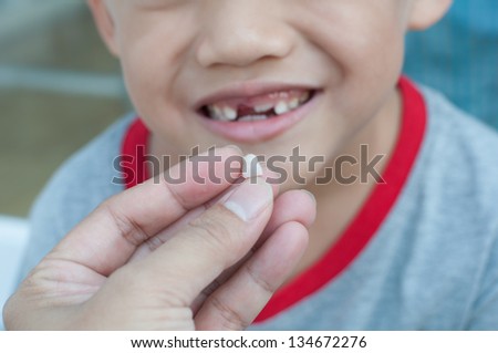 close up of boy mouth with recent loss of upper tooth milk.