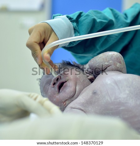 New born infant from cesarean section in operating theater.