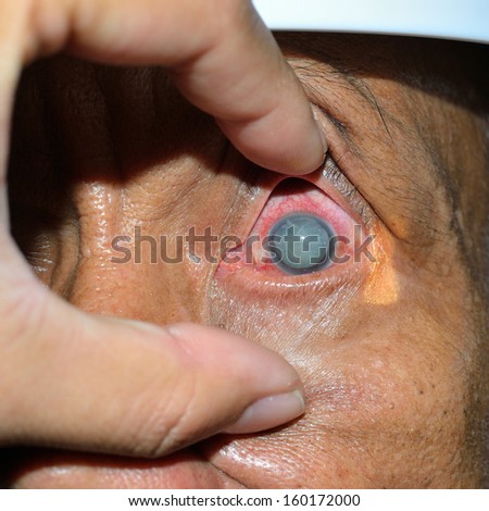 Close up of the len subluxation patient during eye examination.