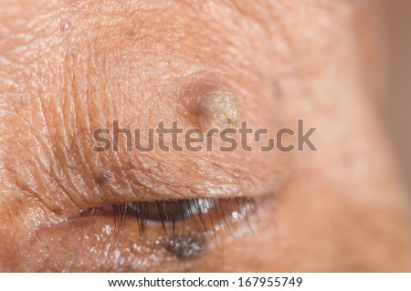 close up of skin tag of left upper eyelid.