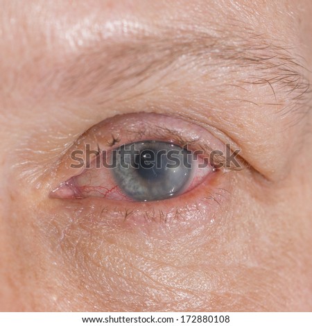Close up of the corneal ulcer during eye examination.