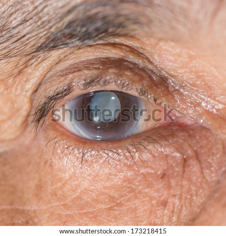 Close up of the senile cataract during eye examination.