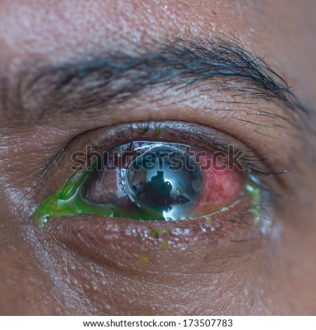 Close up of the traumatic eye ball ruptured during eye examination.