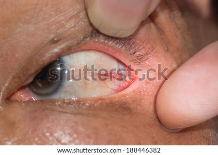 Close up of the conjunctival dermoid cyst during eye examination.