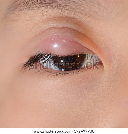 Close up of upper eyelid abscess during eye examination.