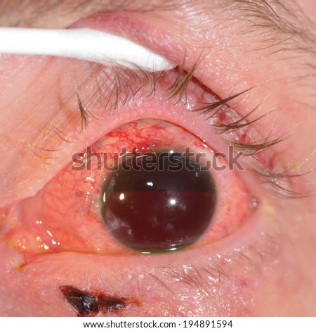 Close up of the hyphema eye during eye examination.