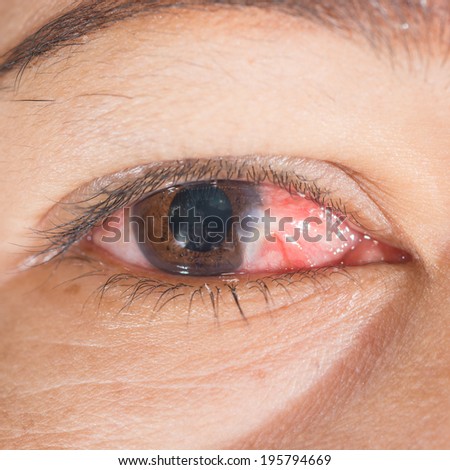 Close up of inflamed pterygium eye during eye examination.