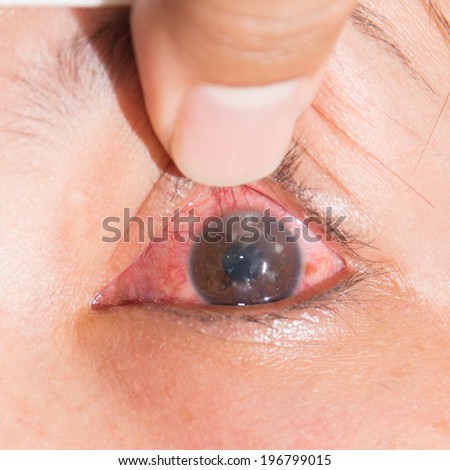 Close up of the corneal ulcer patient during eye examination.