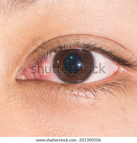 close up of the episcleritis during eye examination.
