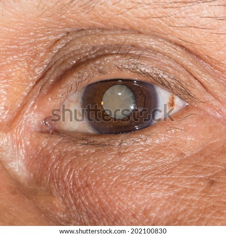 Close up of the mature cataract during eye examination.