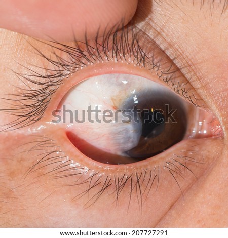 Close up of the pterygium right eye during eye examination.
