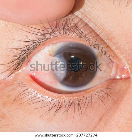 Close up of the pterygium right eye during eye examination.