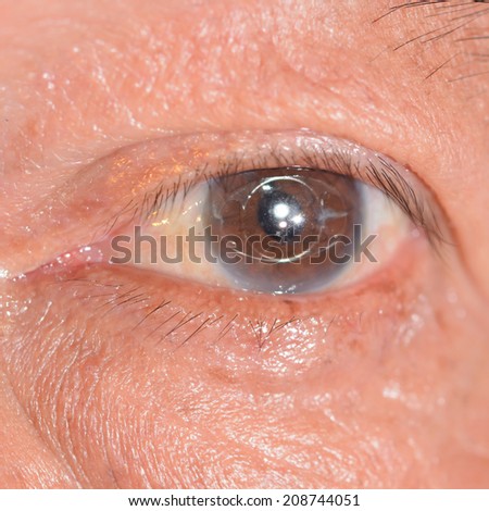 close up of the anterior intra ocular lens during eye examination.