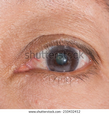 close up of the crneal scar during eye examination.