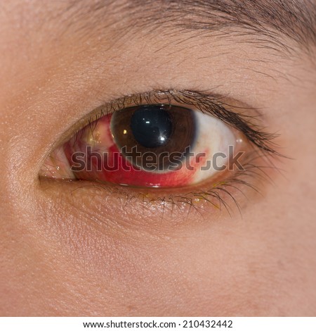 close up of the large Subconjunctival Hemorrhage during eye examination.