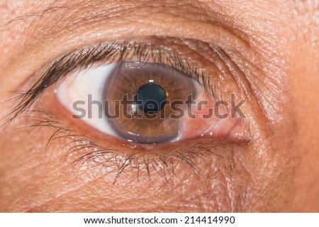 close up of the advance pterygium during eye examination.