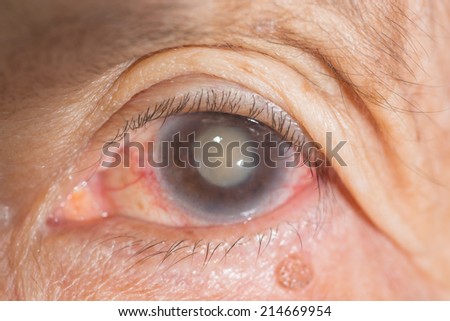 close up of the senile cataract during eye examination.