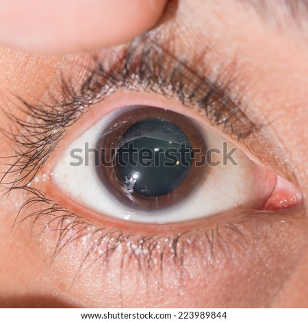 close up of the dilated pupil during eye examination.
