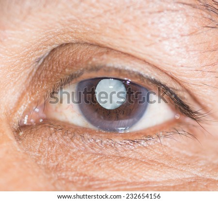 Close up of the eye during ophthalmic examination.
