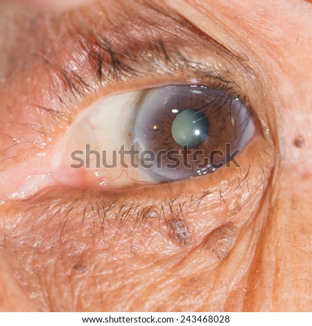 Close up of the  cataract during eye examination.