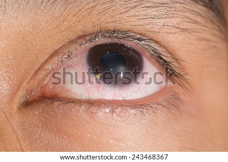 Close up of the linbal stem cell deficiency during eye examination.