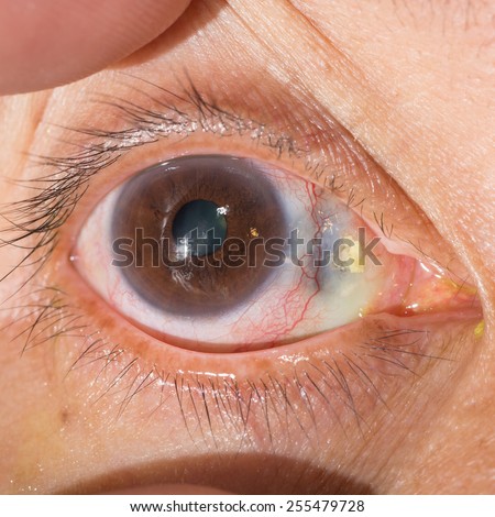 close up of the corneal melting during eye examination.