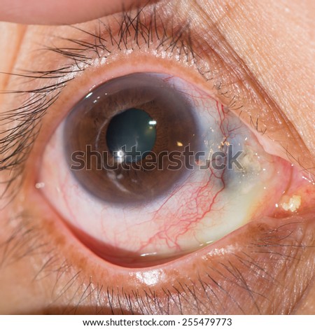 close up of the corneal melting during eye examination.